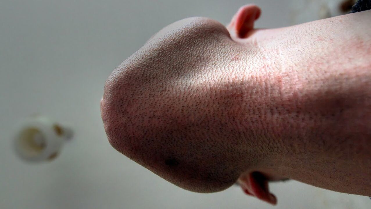 Alcuni prodotti per l’ingrandimento della testa del pene possono causare allergie